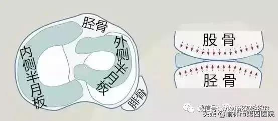 内侧半月板后角损伤怎么治疗,半月板损伤有积液的最好治疗