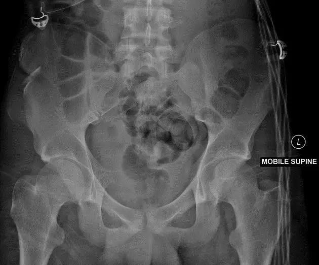 特殊骨折类型,特殊骨折体征