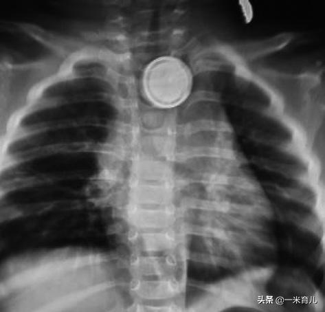 儿童消化道异物处理,小孩吃了耳环塞异物怎么办