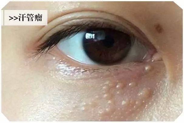 眼周围长出很多小疙瘩是怎么回事,眼睛长了个疙瘩能擦红霉素眼膏吗
