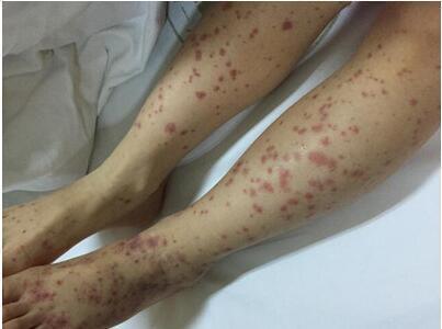 过敏性紫癜呕吐肚子痛怎么治,过敏性紫癜一拉大便就肚子痛