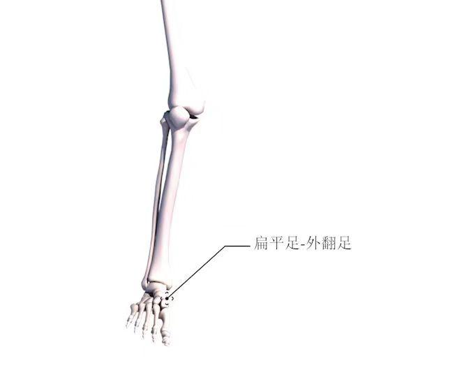 如何改善膝盖内旋腿型,膝盖老是向前弯曲