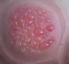 拔罐的知识与视频解说,拔罐如何从罐印判断身体好坏