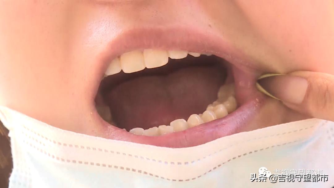 换了烤瓷牙异物感特别强,烤瓷牙多年后感觉吸冷空气牙酥酥