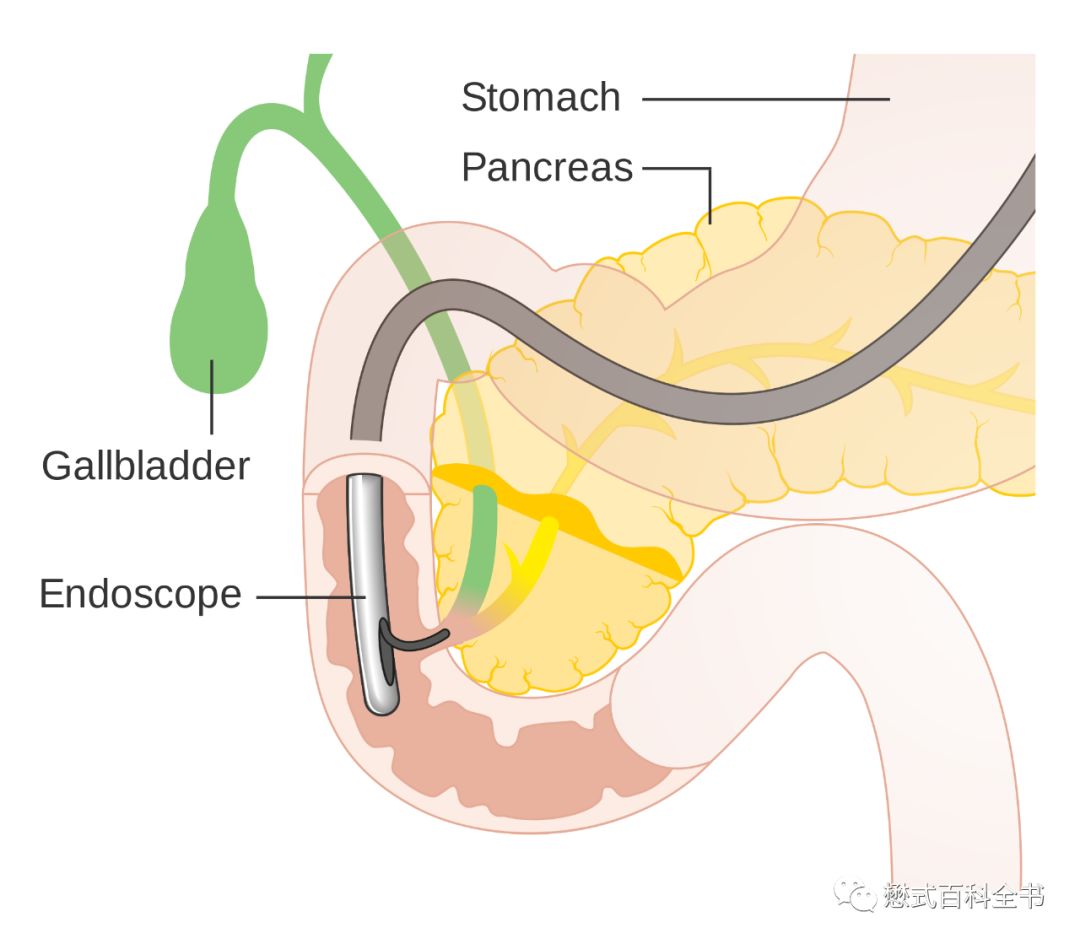 开展mrcp技术,mrcp检查操作流程