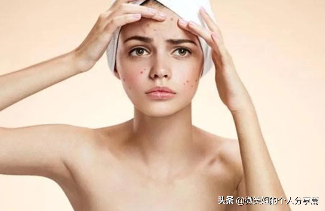 人中下巴反复长闭口粉刺,人中经常长痘痘怎么回事