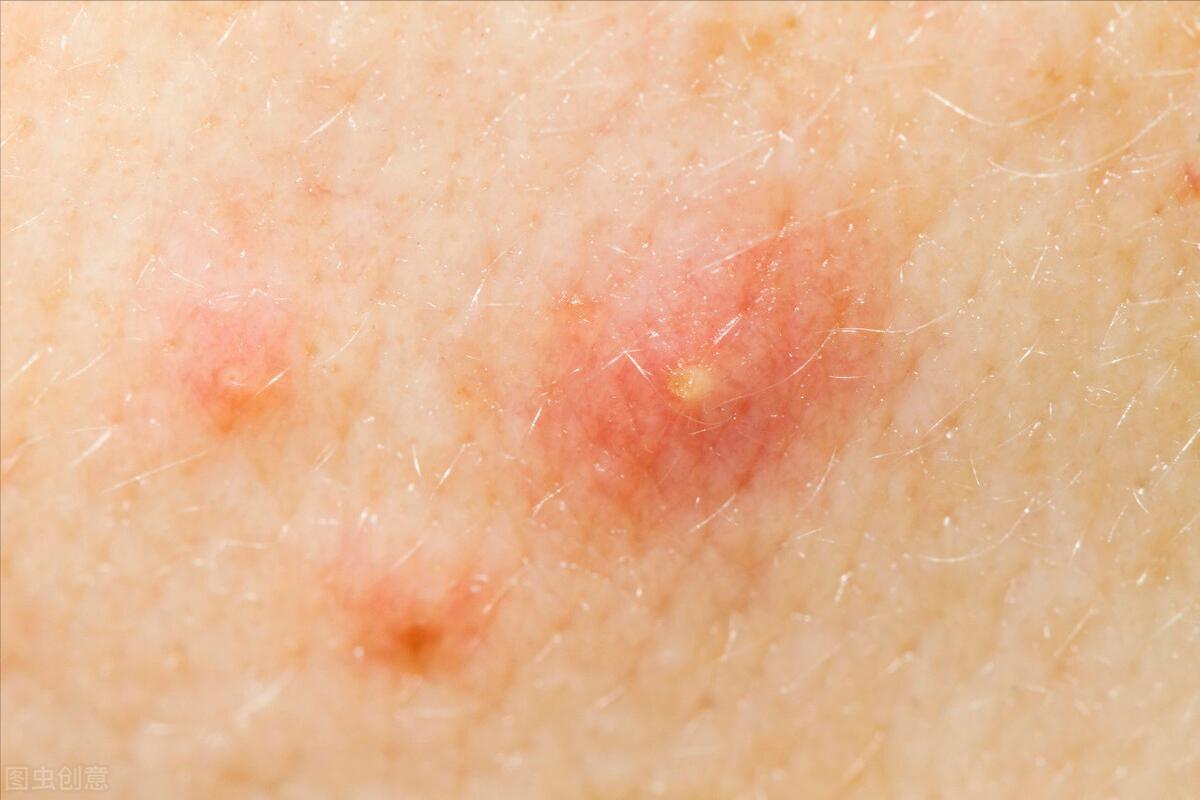 毛囊炎久治不愈可能是糖尿病吗,毛囊炎久治不愈说明有癌症