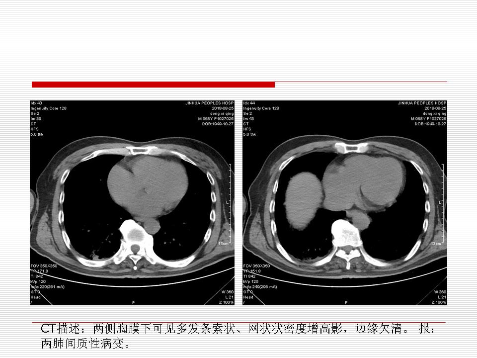 像炎症的肺癌能治好吗,医生说可能是肺癌也可能是炎症