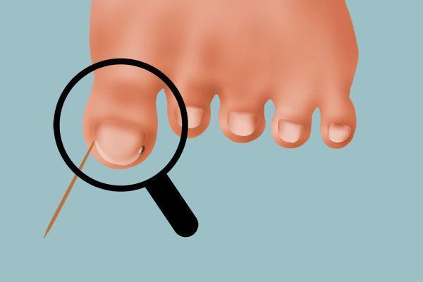 脚趾甲长到肉里面的修剪视频,脚趾甲长到肉里面很痛怎么办