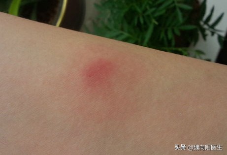 破伤风抗毒素过敏怎么办,破伤风抗毒素过敏正确处理措施