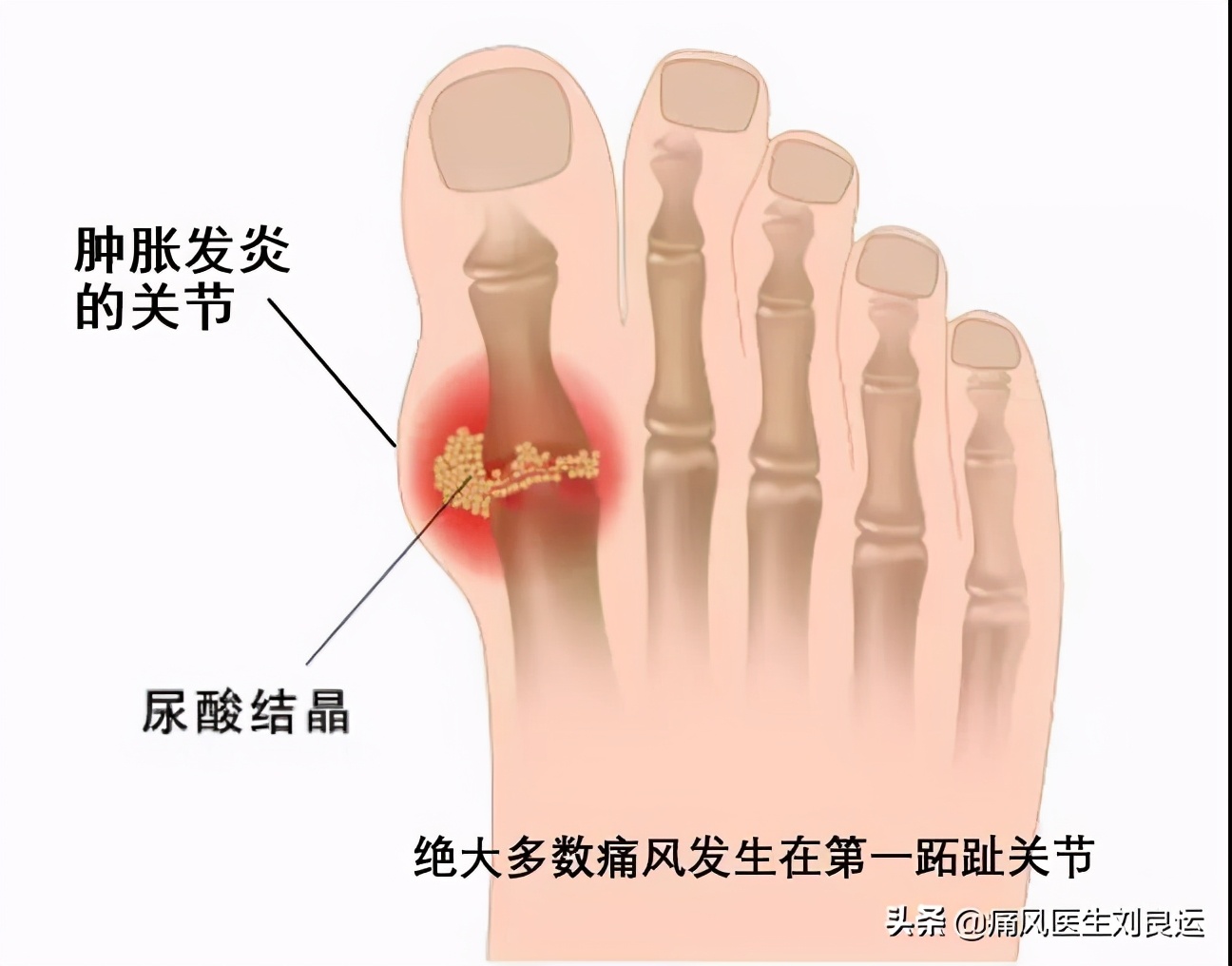 痛风血钙高,尿酸高引起的痛风骨头啥样的