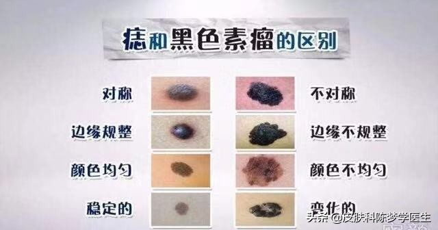 激光点痣后怎么判断有没有癌变,激光点痣会诱发痣癌变是真的吗