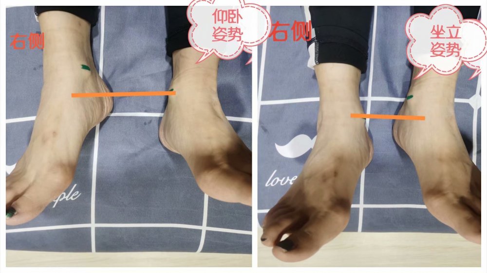 小腿外翻膝超伸如何改善,单侧膝超伸导致腿短一点