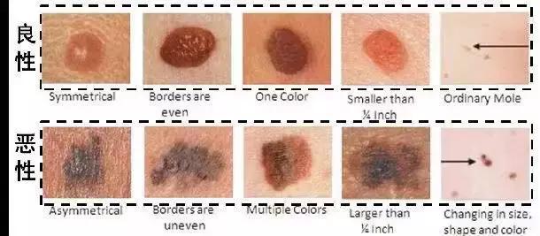 黑痣去除的正确方法是什么,黑痣去除细节注意事项