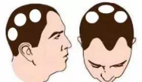 三招防脱告别秃头,防脱小绿瓶拯救你的发际线