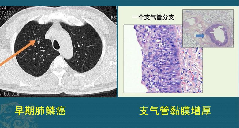 肺鳞癌是怎么长出来的?怎样早期发现?医生教你看CT片
