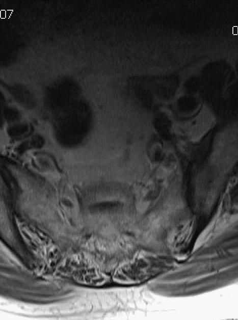 海绵状血管瘤在mri中的影像表现,骶骨处影像显示有血管瘤