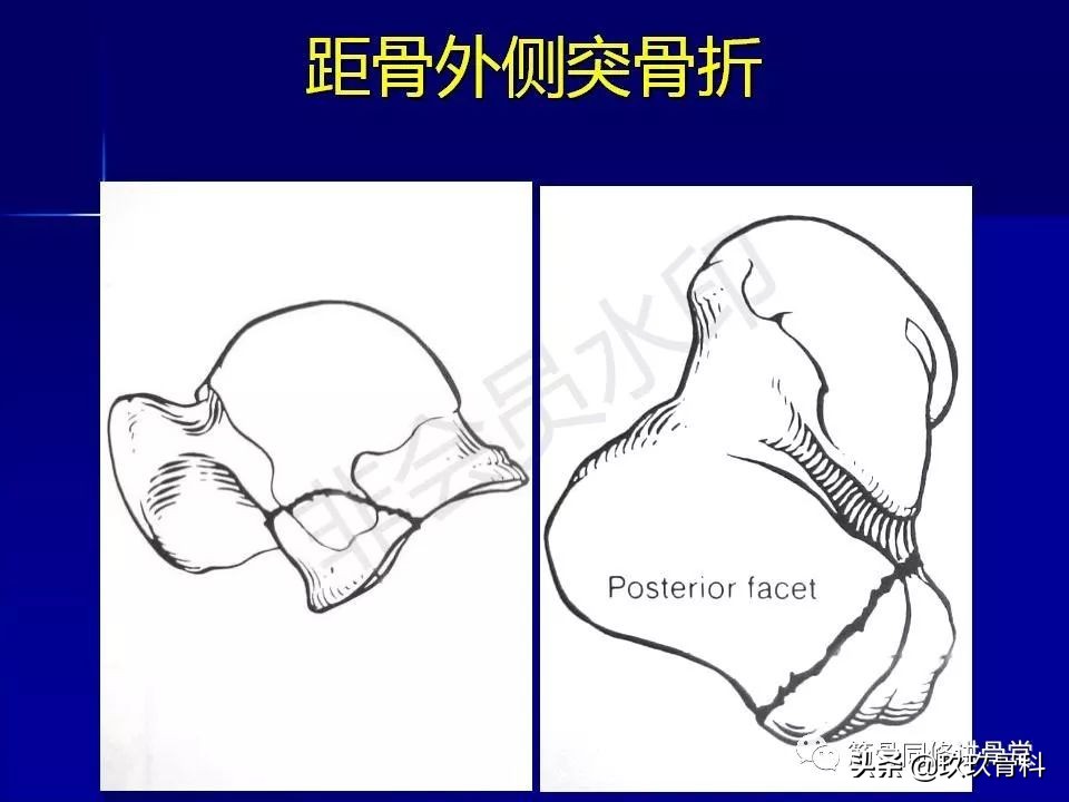 距骨骨折后遗症,距骨骨折怎么办