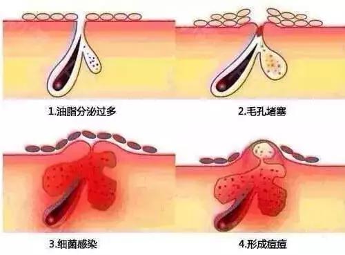 熬夜追《知否》后脸上狂暴痘？这些德国产品可以拯救你的脸！