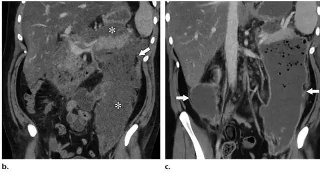 简述急性胰腺炎影像学表现,有关急性胰腺炎疼痛的图片