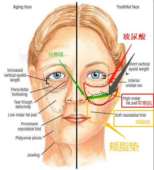 张歆艺用的什么填充脸部,张歆艺填充脸部前后对比
