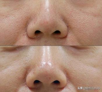 肌肤毛孔粗大出油,油性皮肤毛孔大怎么办