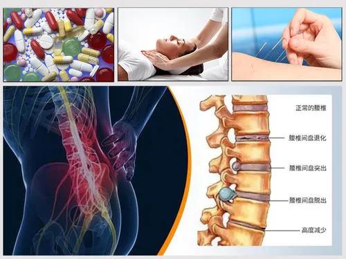 25岁得了腰椎间盘突出4年了,50岁腰椎间盘突出腰疼