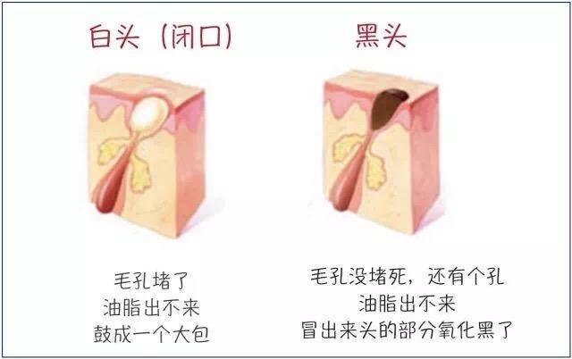 去黑头粉刺最好的建议,真正有效祛黑头粉刺