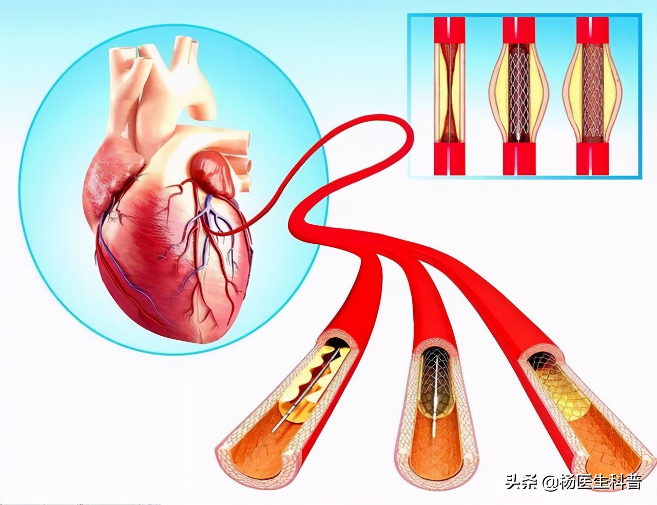 放支架后吃阿司匹林还是吡格雷好,波立维能和艾司奥美拉唑一起吃吗