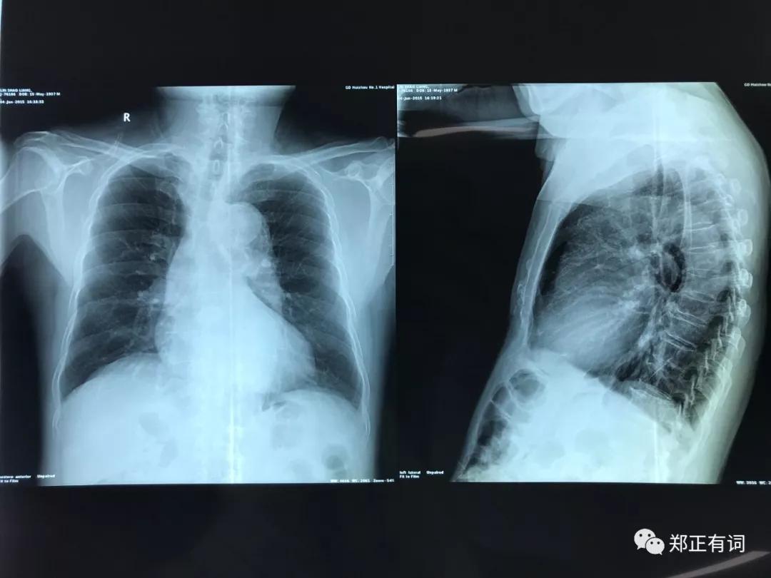 老年人肺癌不治疗能活多久,老年人得肺癌晚期不治疗能活多久