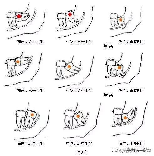 拔智齿不长平咋办,拔第二磨牙不拔智齿可以吗