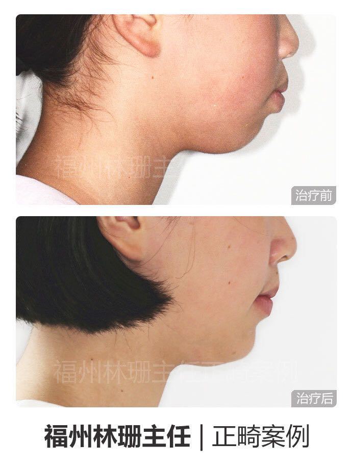福州牙齿矫正林珊主任｜浅谈下颌后缩