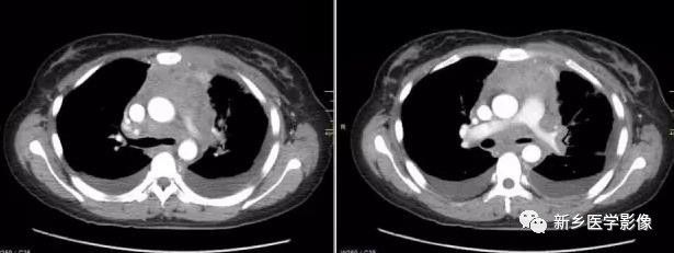 前上纵隔高密度影考虑胸腺未退化,肺纵隔胸腺结节12mm看什么科