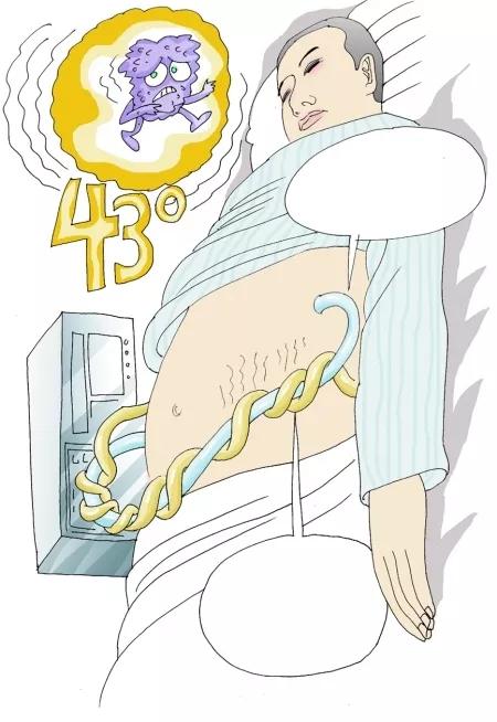 肿瘤热疗能杀死癌细胞吗,人体温度43度以上可以杀死癌细胞