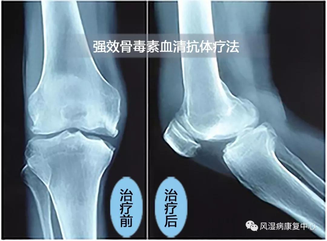 膝盖关节炎天冷了怎么就犯了,关节炎秋季