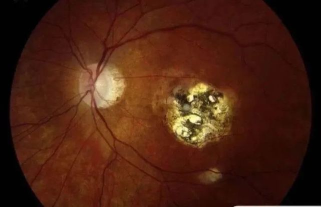 男孩视力严重下降新闻,男子视力突然下降确诊脑梗死