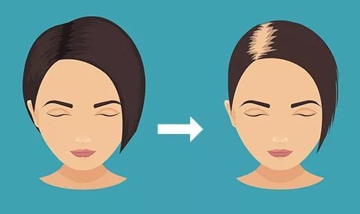 秃顶这件事就过不去了？两项新研究为治疗脱发带来新希望