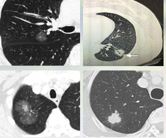 华西廖正银教授治肺结节,华西医院肺癌专家唐小军