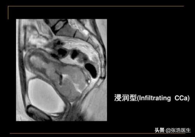 女性宫颈癌发生概率,宫颈癌淋巴结转移到肺部会怎样