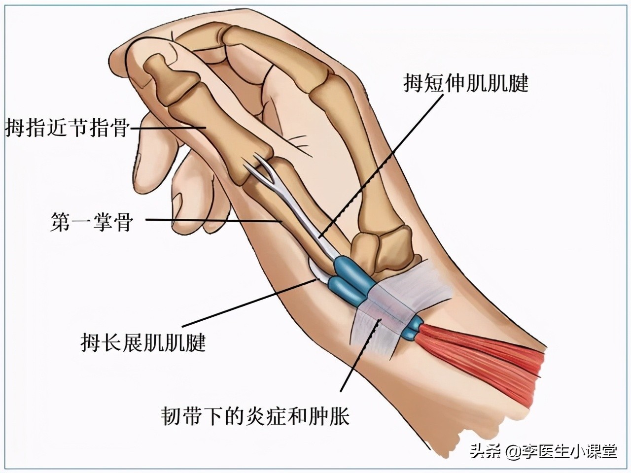 女性更年期大拇指腱鞘炎怎么治,更年期女性为什么会得腱鞘炎