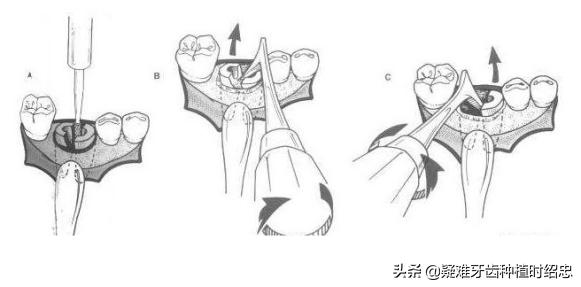 只剩残根的牙真的能补救吗,烂的只剩下黑色残根的牙怎么处理