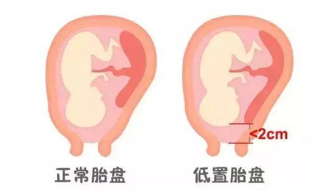 后壁胎盘出现了胎盘低置怎么办,怎么预防前置胎盘和胎盘低的发生