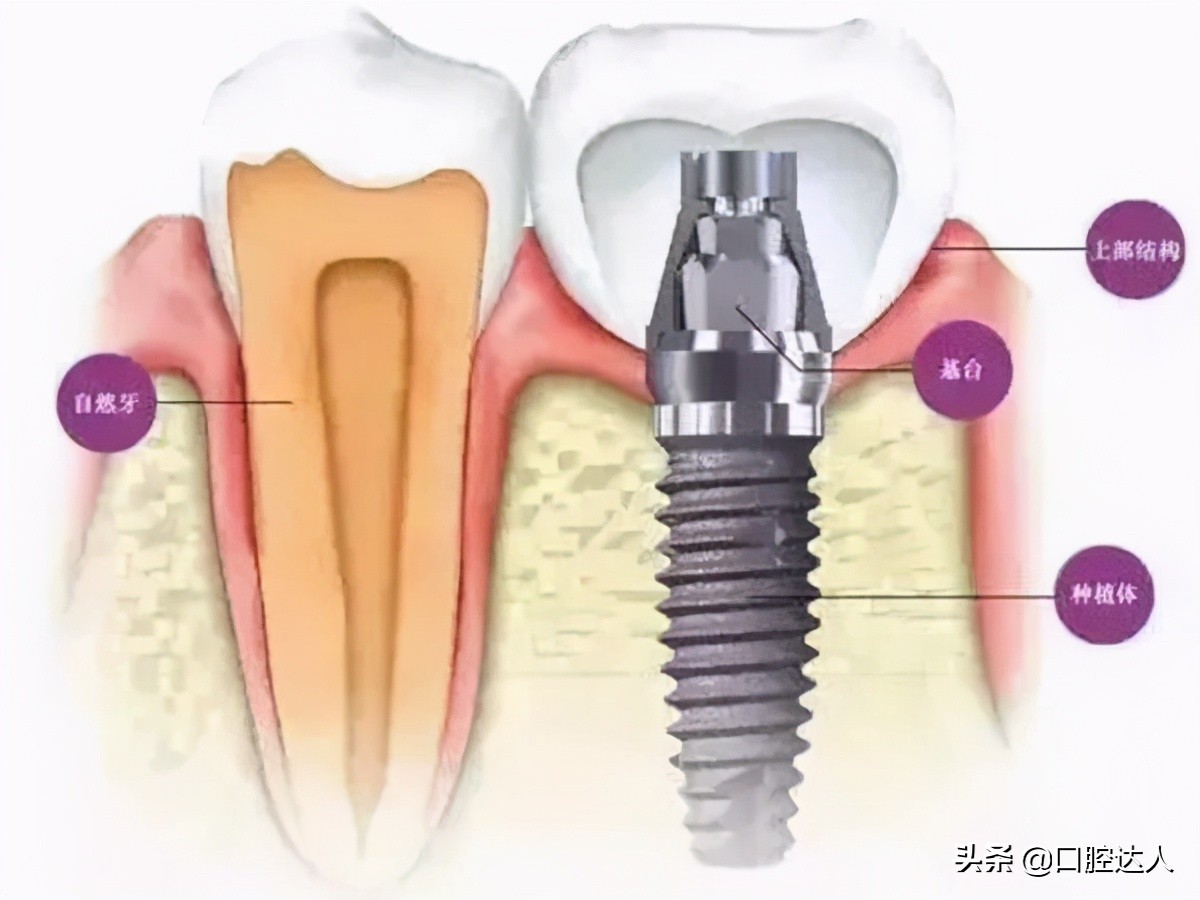 种植牙流程是怎么样的,种植牙基台安装流程