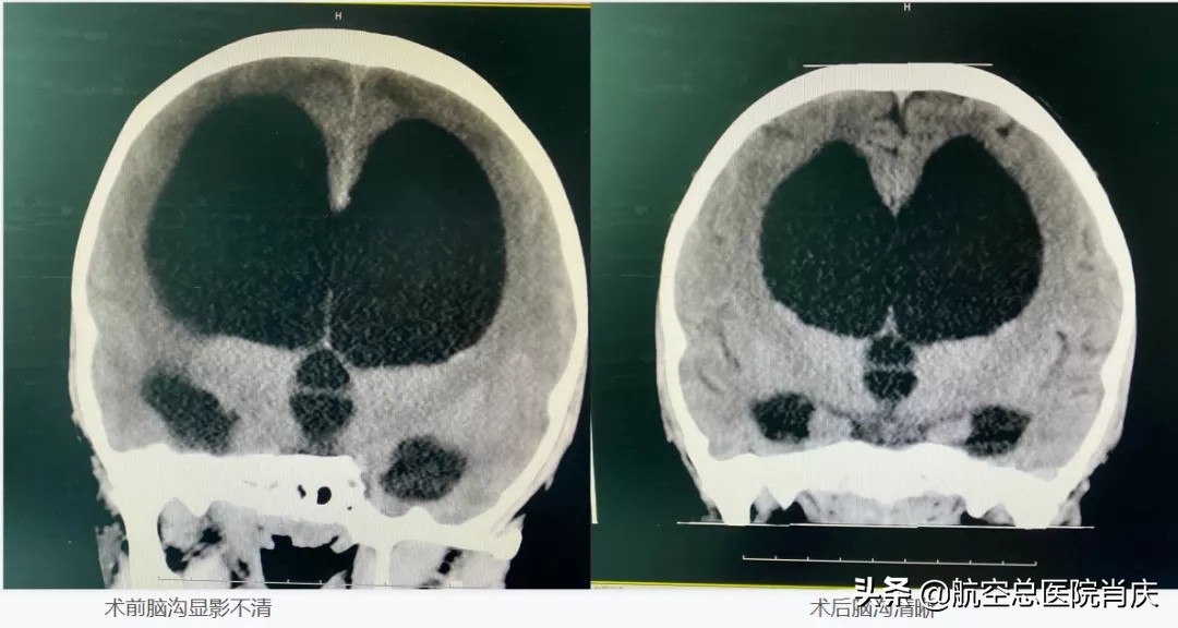 软性神经内镜，给花季少女一个终身不带管的机会