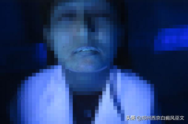 白癜风治疗前后对比图,白癜风治疗中为什么白斑更加白呢