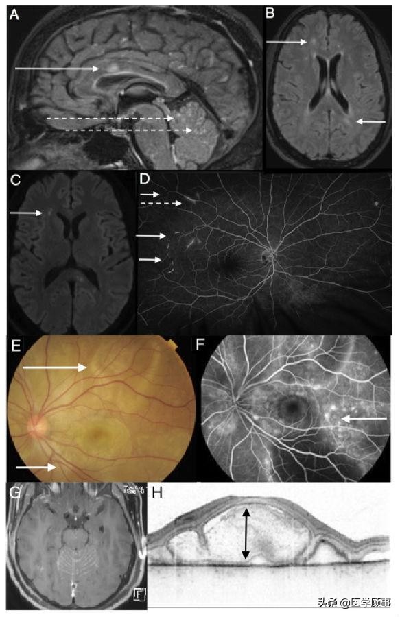 小柳原田综合征需要配眼镜吗,小柳原田综合征是罕见病吗