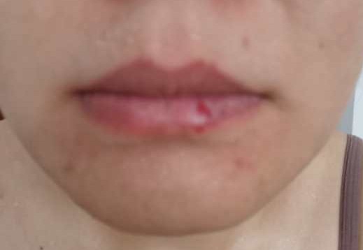 治疗一例咽痛如刀割状、牙痛、唇部疱疹者，一副药未尽剂而愈。