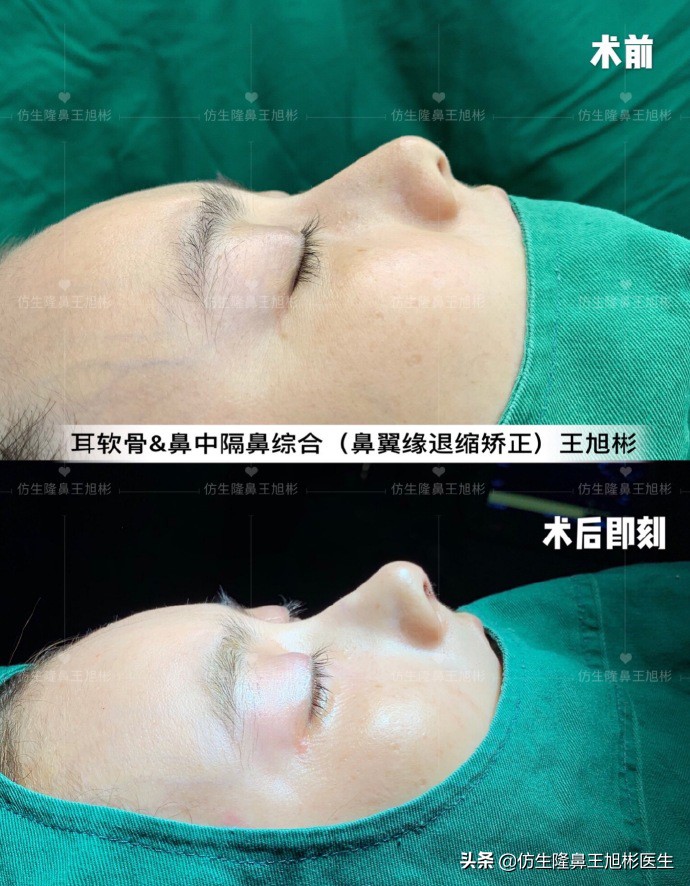 王旭彬：朝天鼻、露鼻孔，模特菲菲短鼻矫正手术后1.5个月