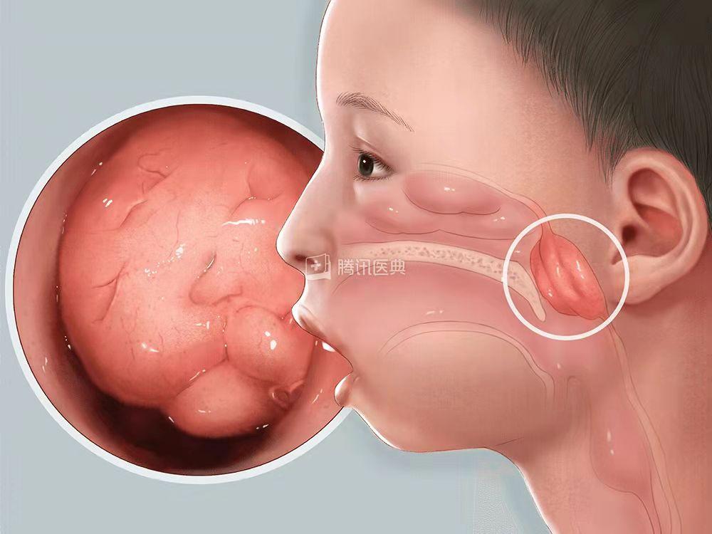 3岁孩子打呼噜感觉嗓子有东西,3岁孩子睡觉打呼噜还咳嗽一下