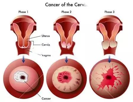 宫颈锥切后为什么会引起不孕,宫颈锥切一个月后怀孕了可以生吗